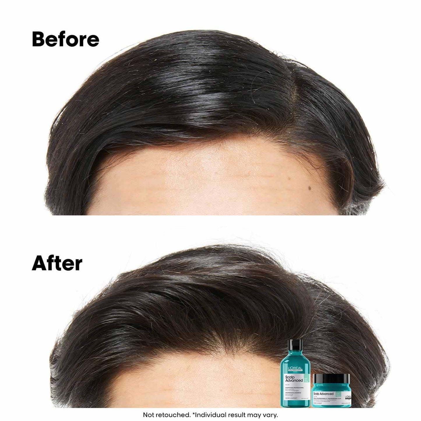 L’Oréal Professionnel Scalp Advanced Anti-Oiliness Dermo-Purifier Shampoo (300 ml) for Oily Scalps