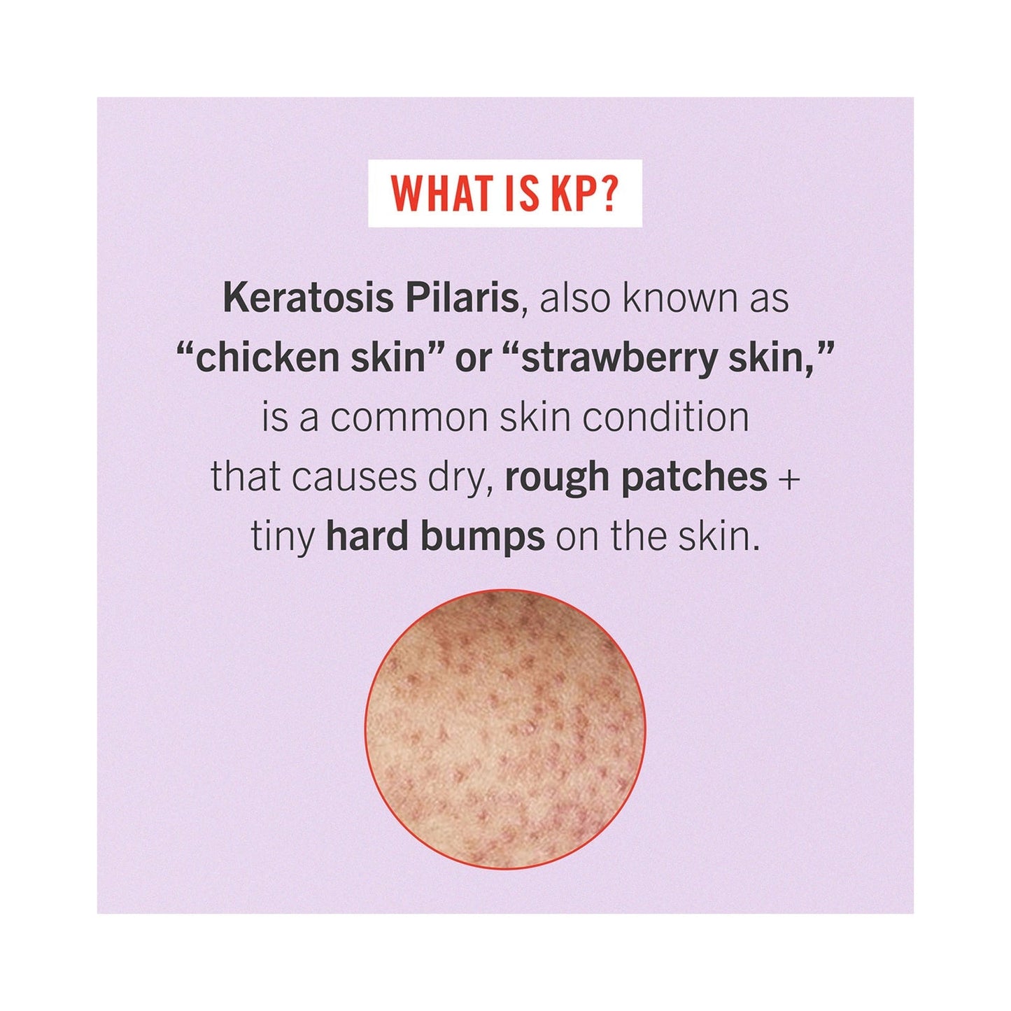 First Aid Beauty KP Bump Eraser Body Scrub With 10% AHA (56.7g)