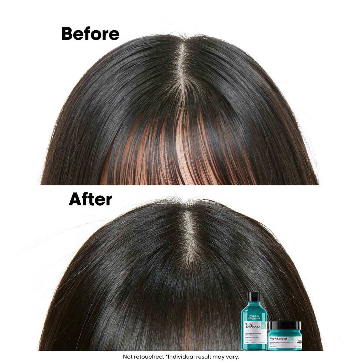 L’Oréal Professionnel Scalp Advanced Anti-Oiliness Dermo-Purifier Shampoo (300 ml) for Oily Scalps