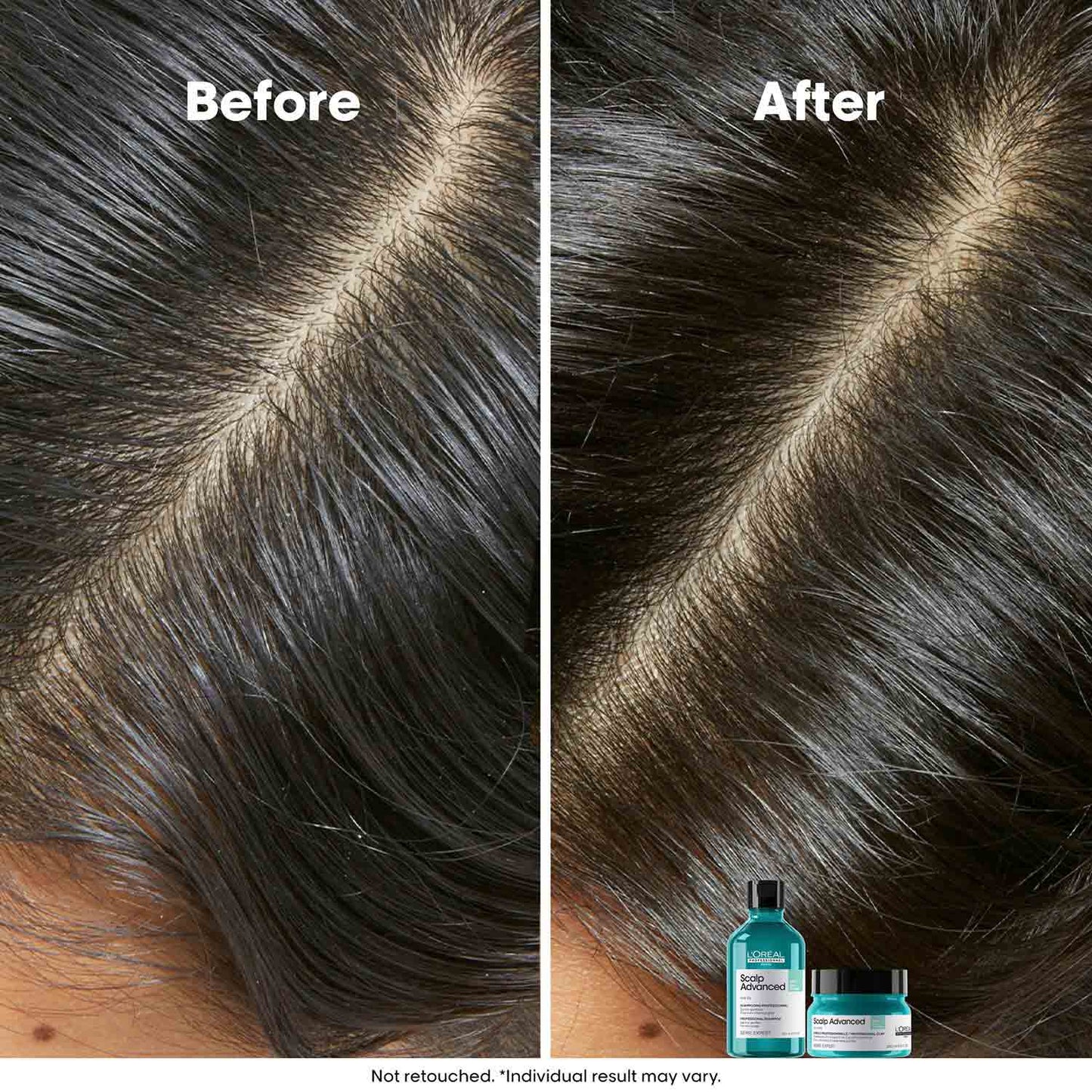 L’Oréal Professionnel Scalp Advanced Anti-Oiliness Dermo-Purifier Shampoo (300 ml) for Oily Scalps